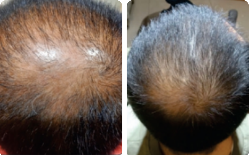 Hair result — crown restoration