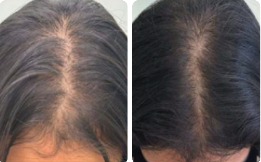 Hair result — thicker crown