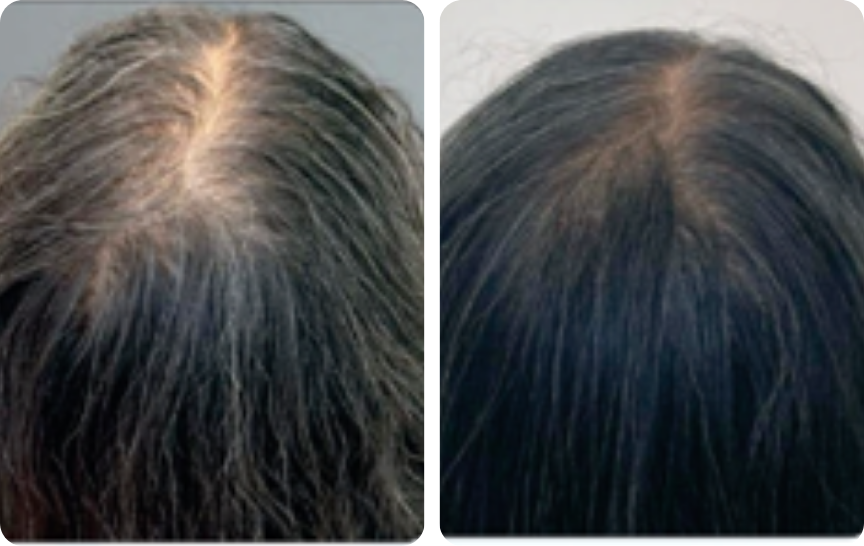 Hair result — part-line density